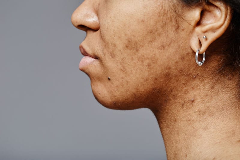 Professional Esthetics example of skin condition | ESI Show