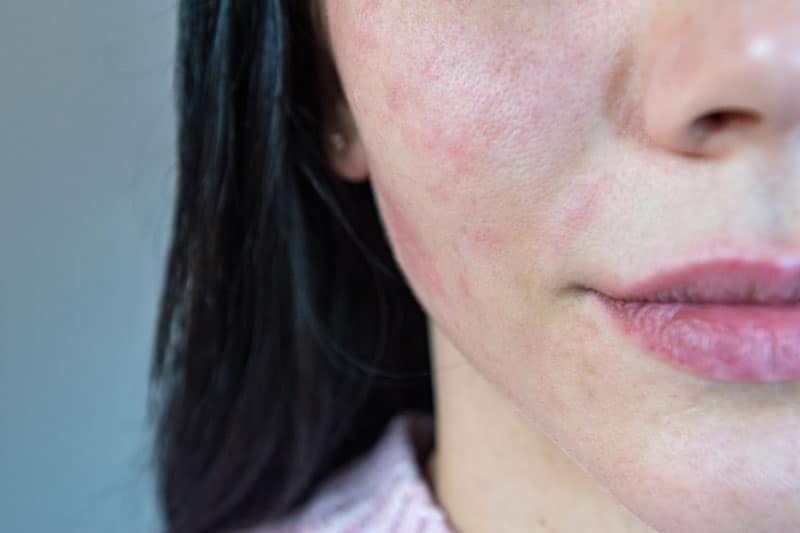 Traitements professionnels de la peau d'une femme ayant la peau sensible | ESI Show