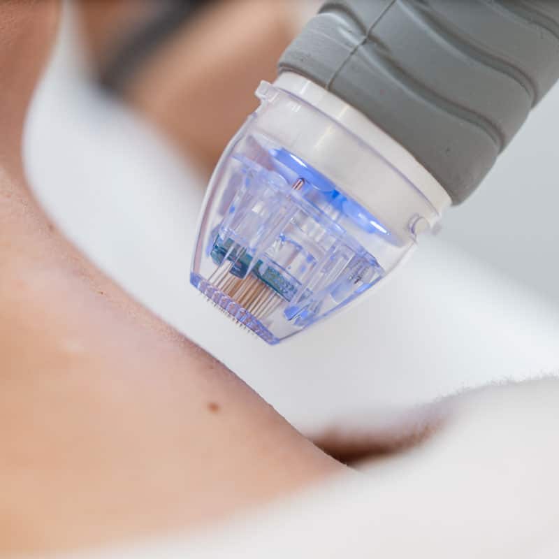 Microneedling comme traitements professionnels de la peau | ESI Show