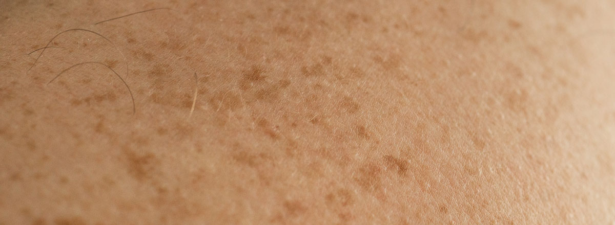 Acné, vieillissement cutané et problèmes de peau démontrant pigmentation | ESI show
