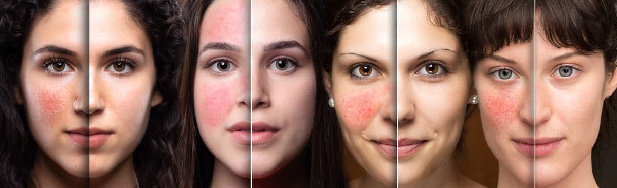 Exemples de traitements professionnels de la peau | ESI Show